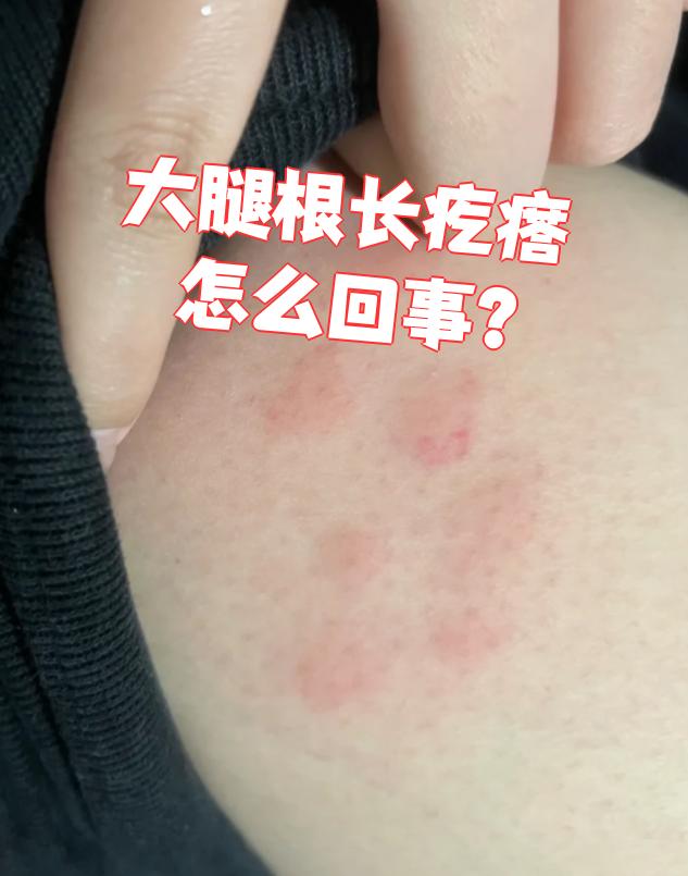大腿根长疙瘩怎么回事?