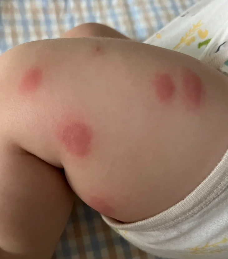 孩子发高烧时身上起像蚊子包一样的疹子,可能是荨麻疹,也可能是病毒
