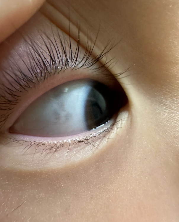 孩子眼白有黑斑怎么回事?