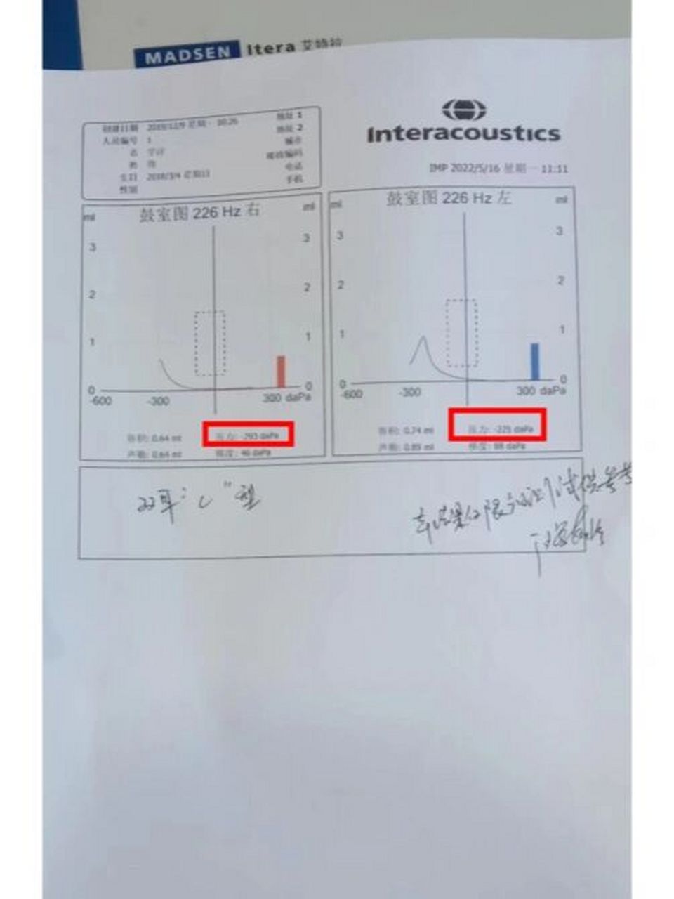 教你如何看声导控报告 本周专家小贴士:一分钟看懂声阻抗----- 正常人