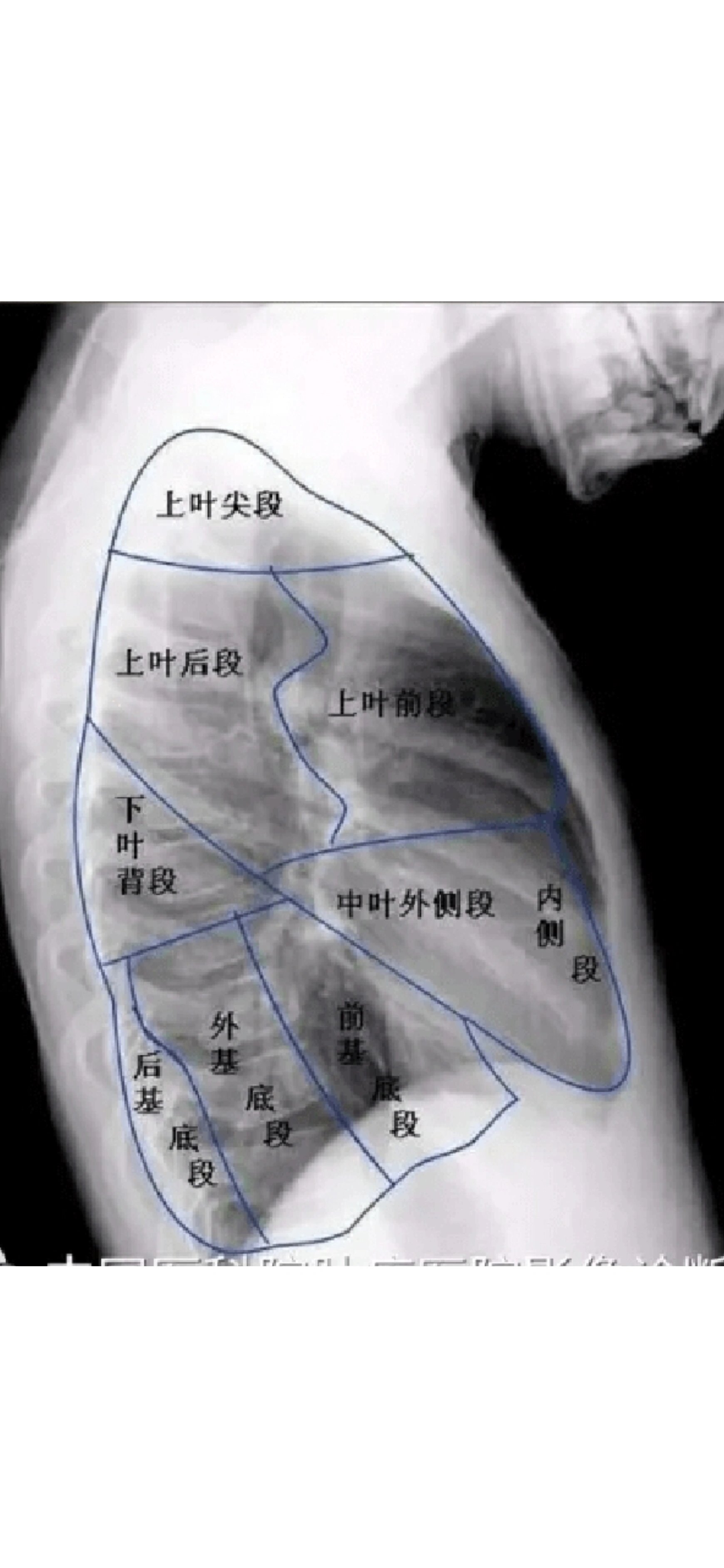 肺部x光片怎么看图片