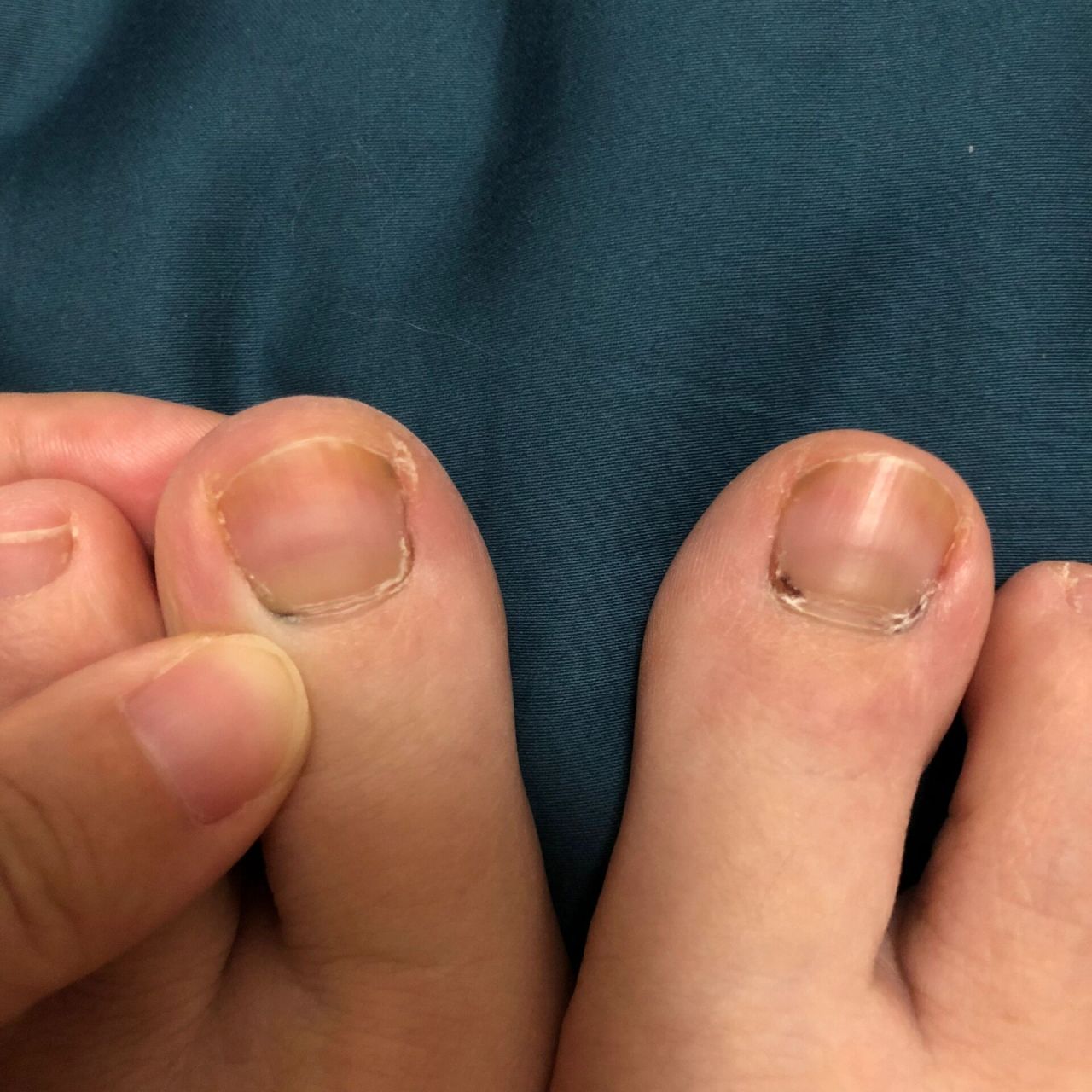 脚趾发黑 生完娃1个月的时候,大脚趾一直微微痛,以为是生完之后缺钙