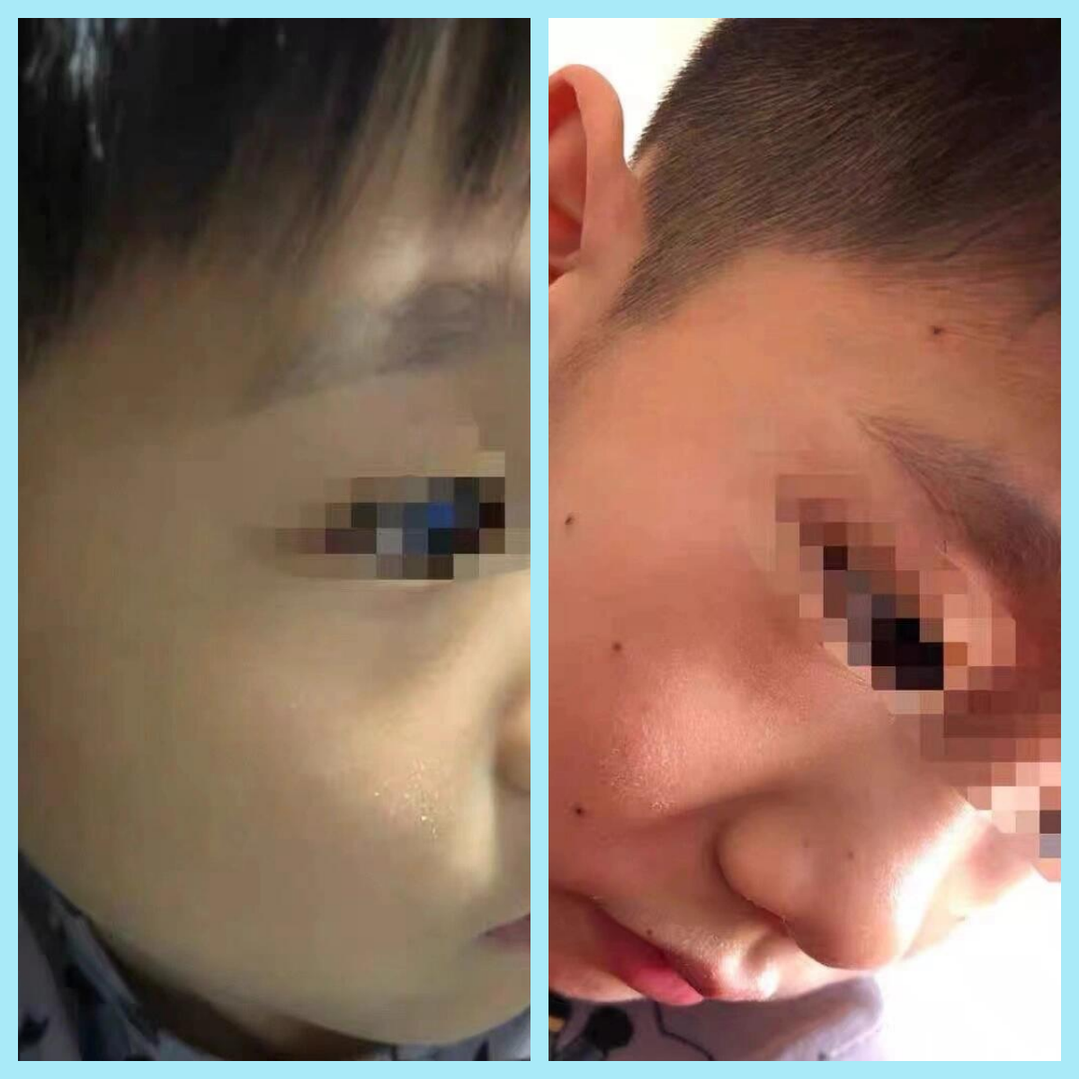 姐妹们,是不是都有这样的困扰,脸上有很多蚊子屎和黑点点,化妆都盖不