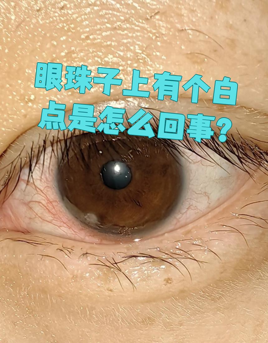 眼珠子上出现白点可能有几种常见原因,需要根据具体情况来判断