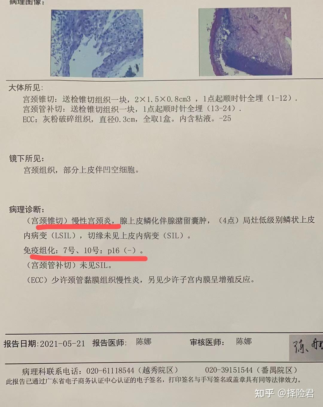 宫颈高级别病变ciniiiii理赔分享二