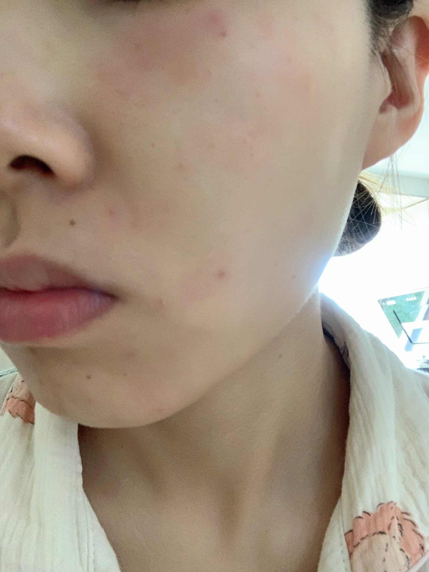 脸突然过敏,坚持不洗脸竟然痊愈了