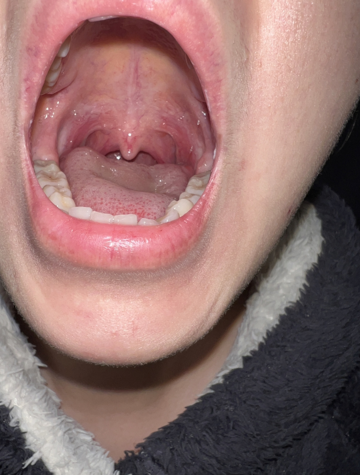 吃了花生后嗓子痒,想咳嗽,可能和几种情况有关