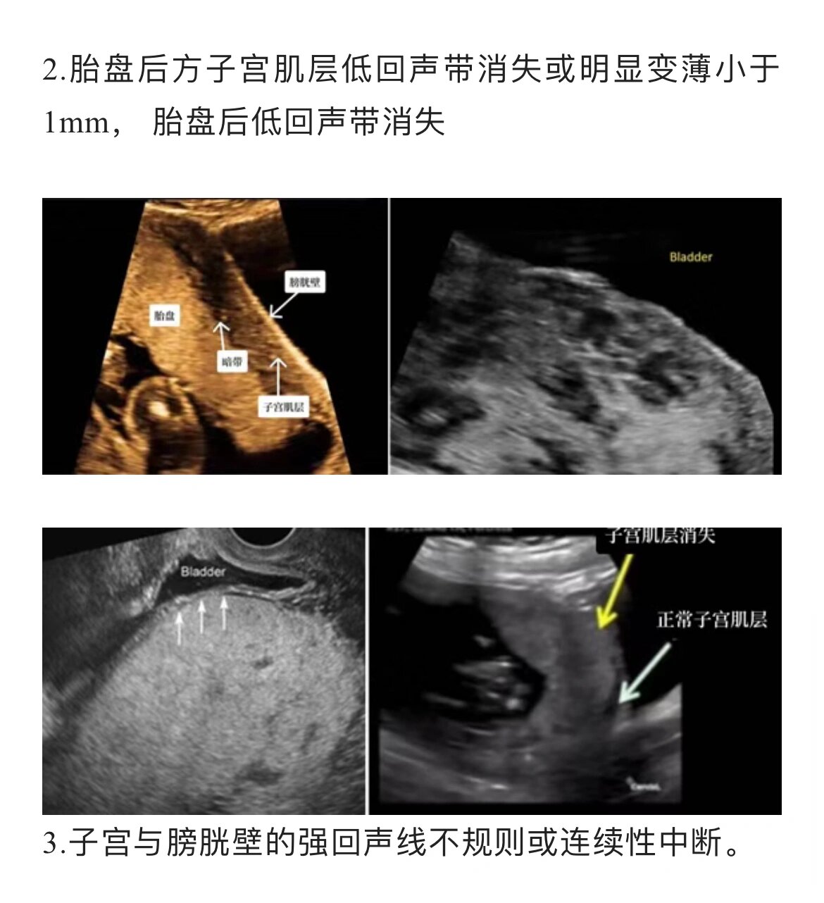 副胎盘超声声像图图片