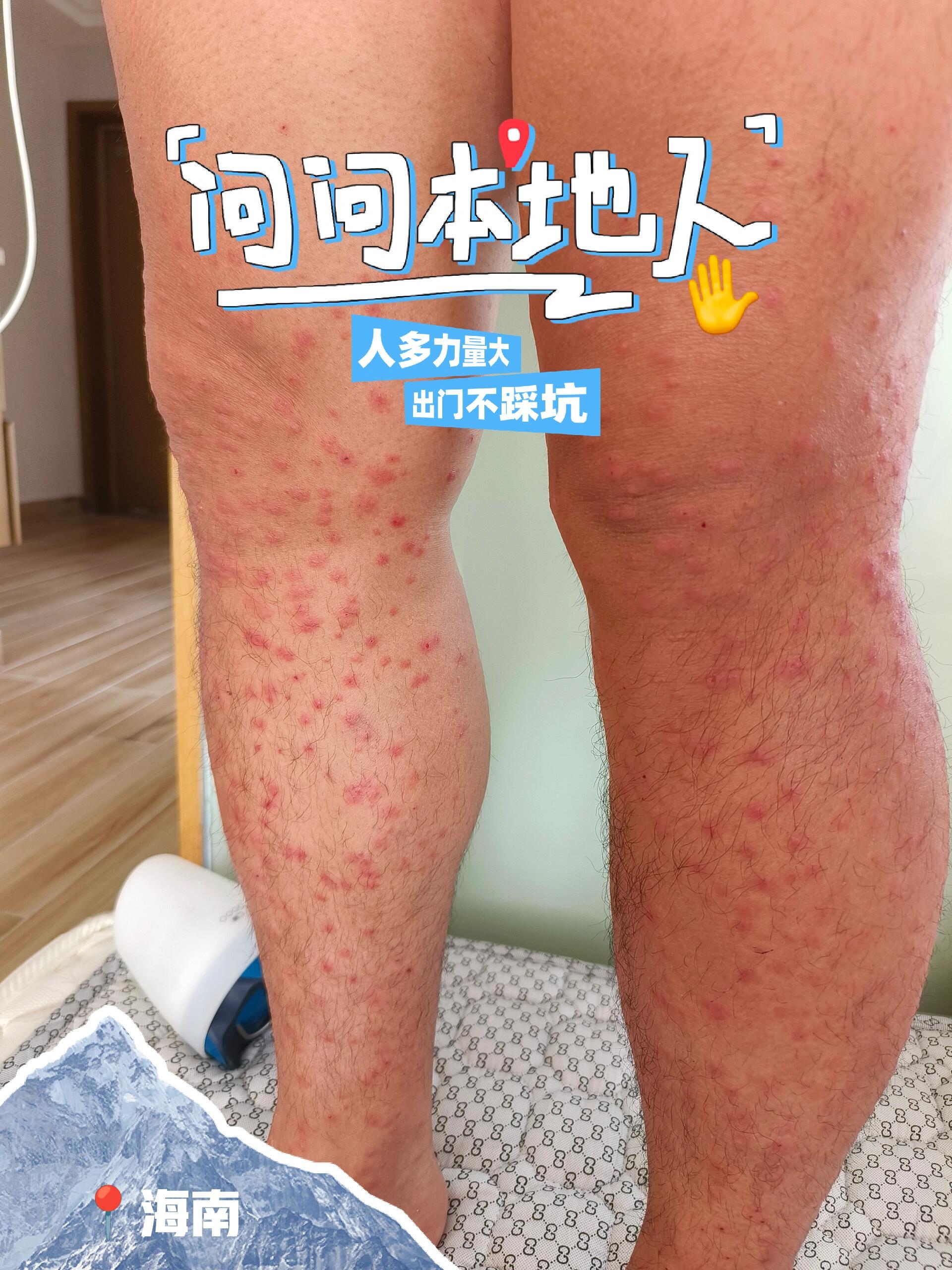 真实记录 问一下,海南应该是被槟榔虫咬成这样～已经越来越肿了～咋办