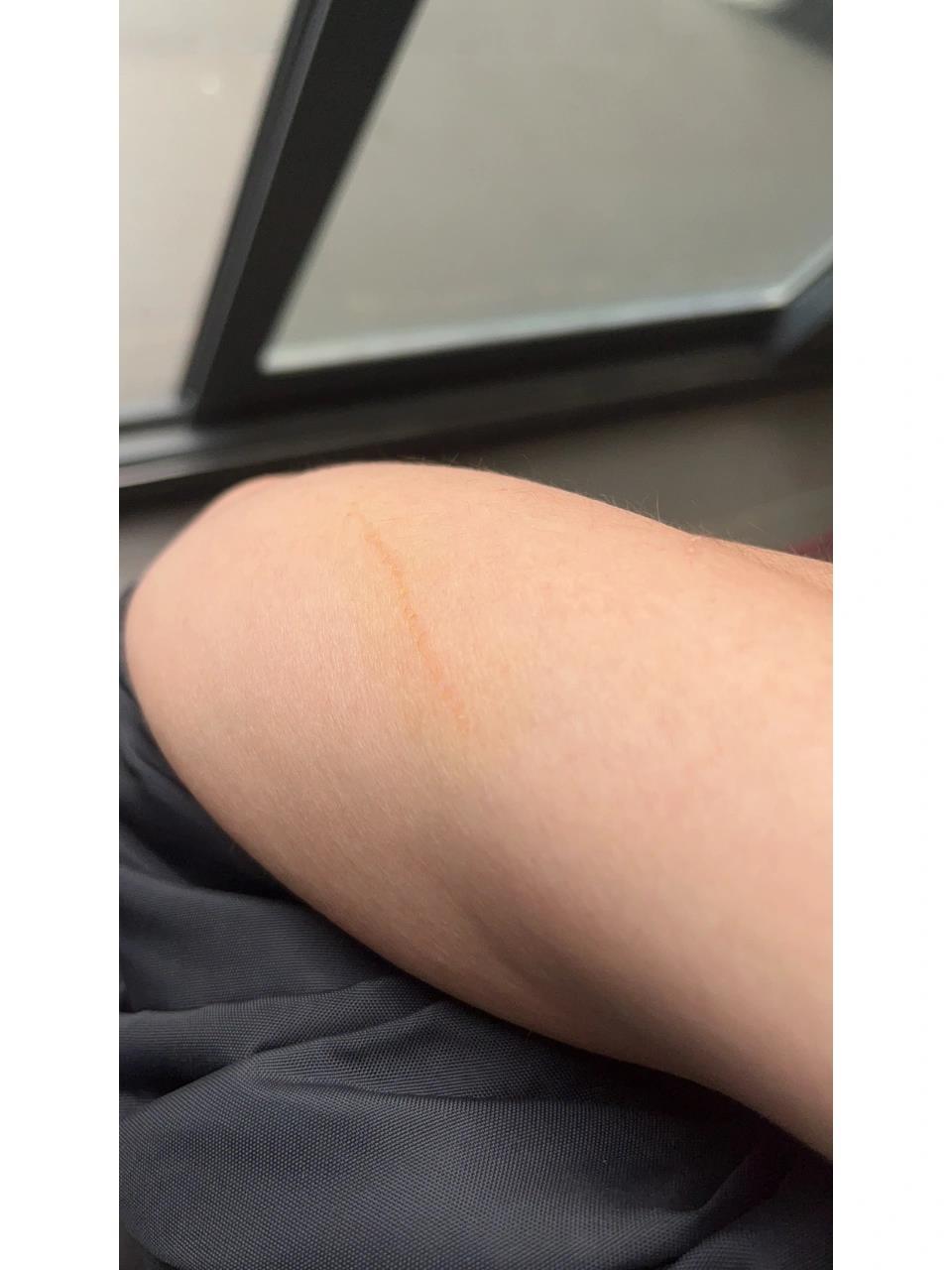 狗狗抓破皮 被狗狗爪子刮破了一点皮,没有出血,红色是涂了碘伏,我这种