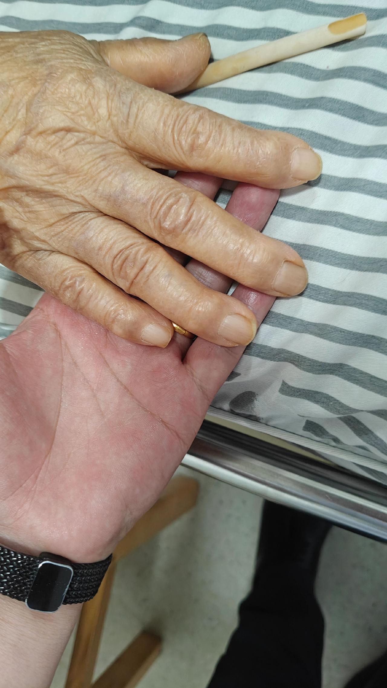 这个是贫血的手,看明白了吗?