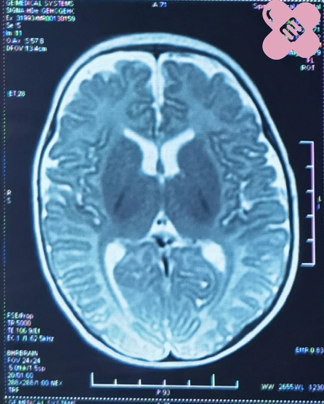 早产儿|这张头颅mri有什么问题?