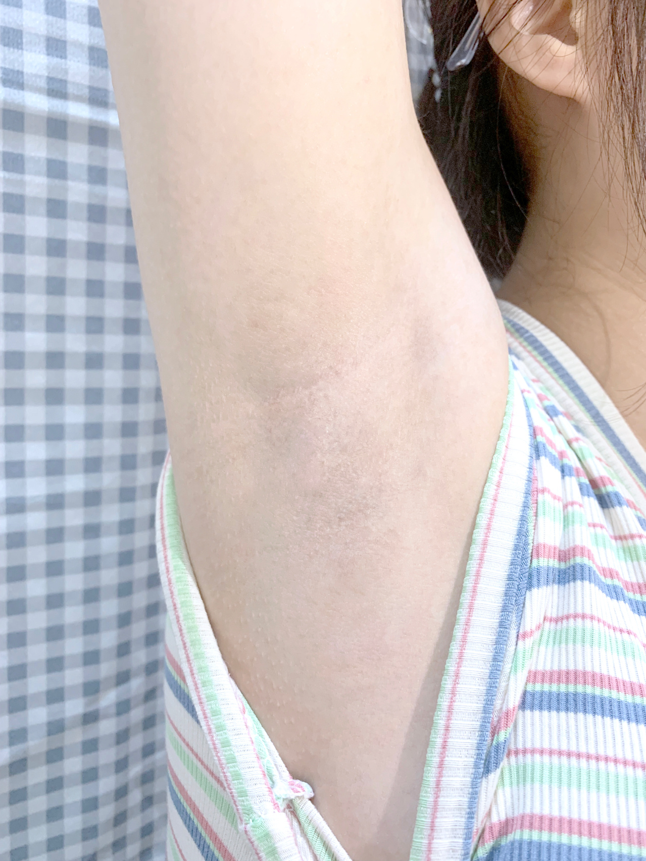 脱毛后腋下黑怎么办7171跟着做一起变白  姐妹们是不是脱毛后腋下