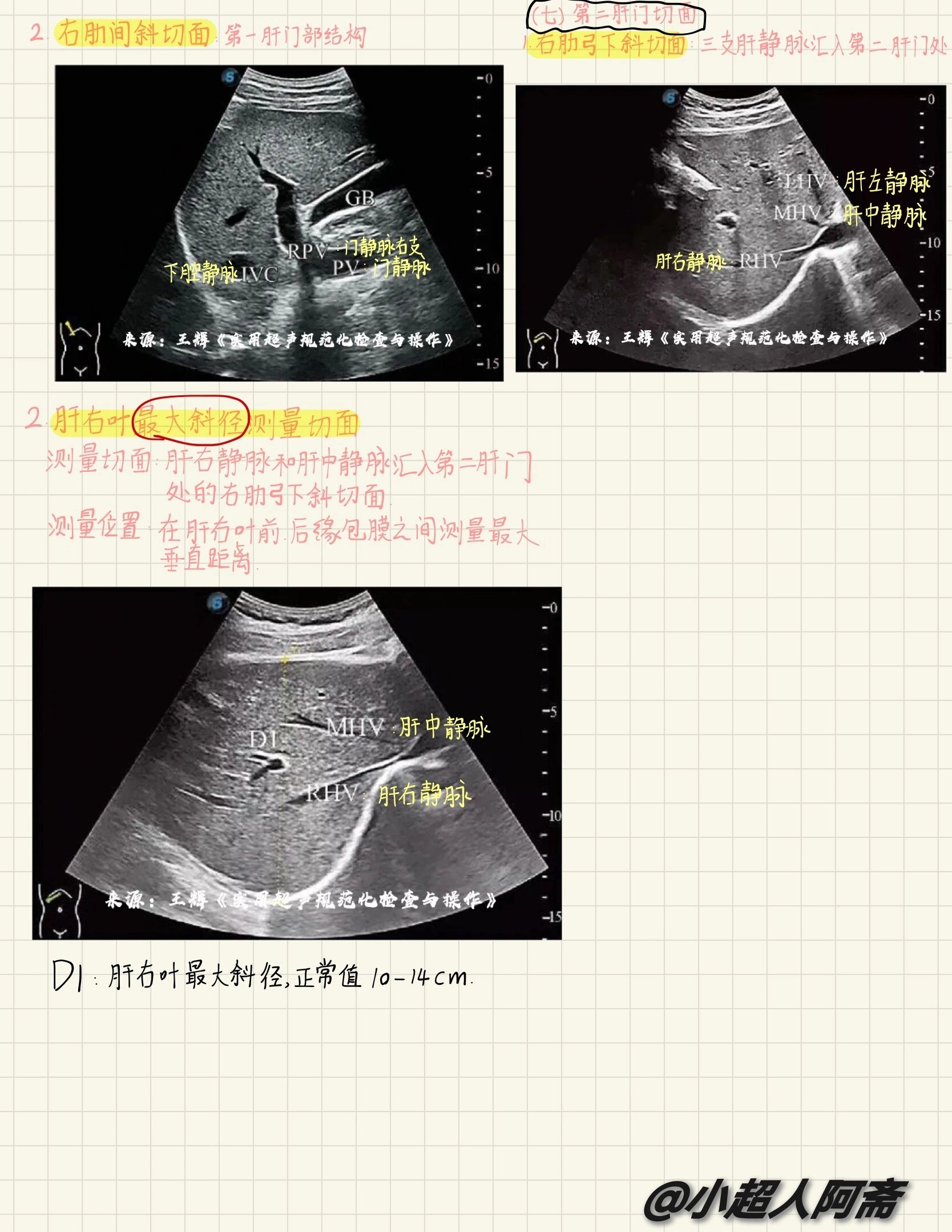 肝脏超声飞鸟征图片图片