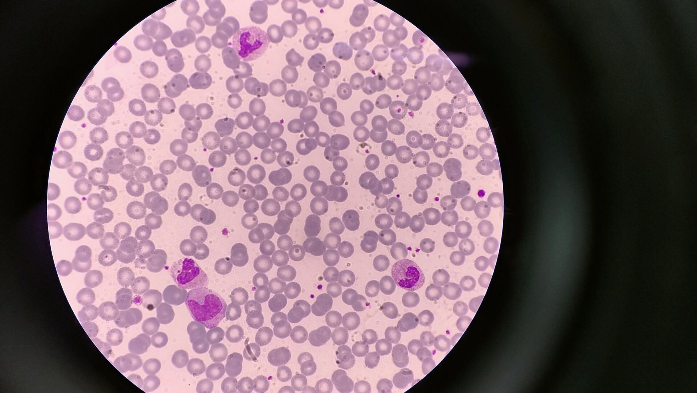 分享今日血标本 还是得多练练推血涂片