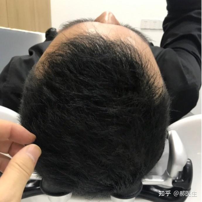 河南植发哪家强(河南植发研究院是真的有效果吗)