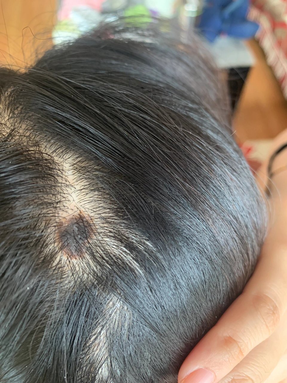 头发里的痣到底要不要切? 发顶有一颗1.2*1.