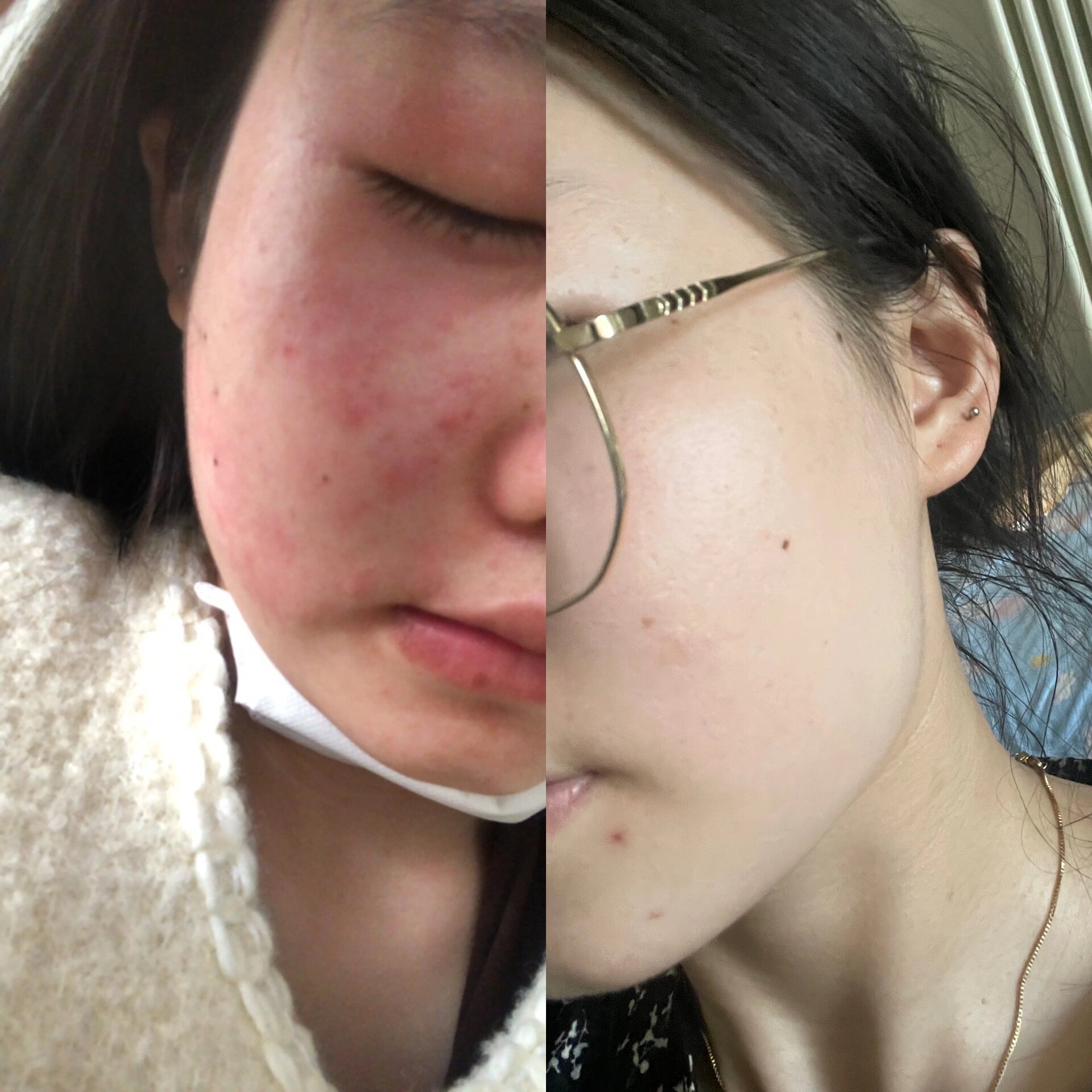 图片本人对比照:敏感肌肤 ,容易过敏 起水泡 如何维持敏感肌的稳定