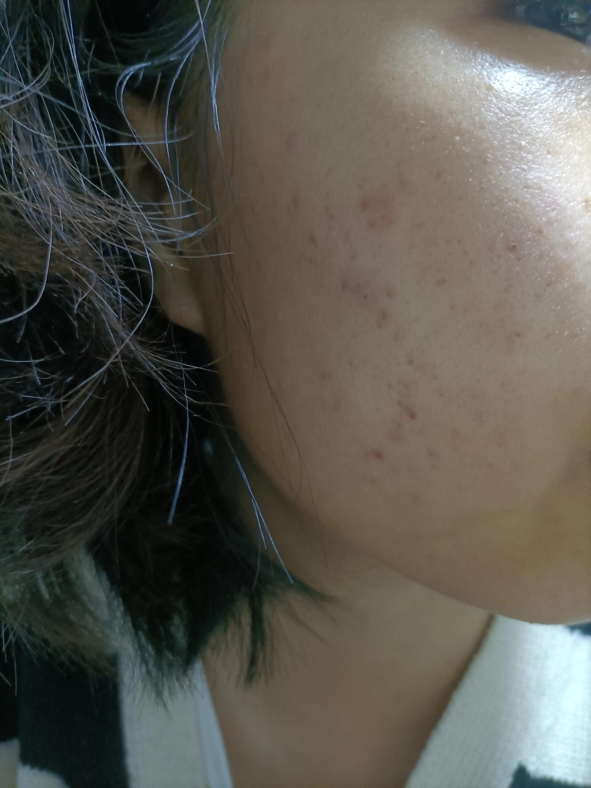 甲硝唑凝胶治疗第一天!