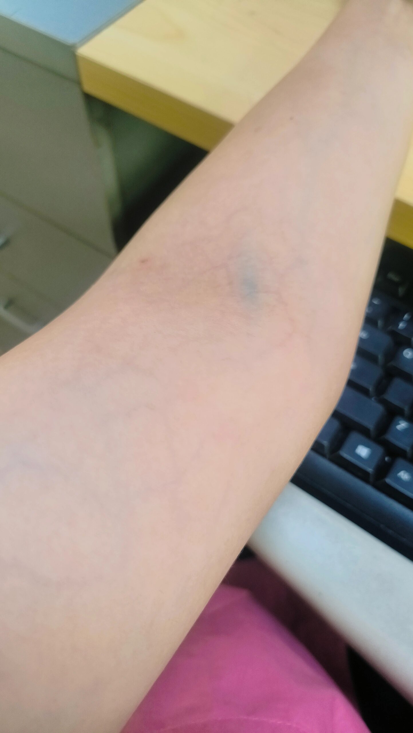 手臂上细红色的血管明显是怎么回事?