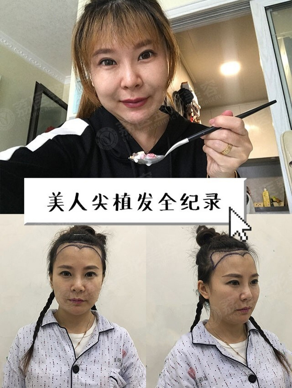 【广州荔医案例】美人尖植发全纪录 美人尖又称美人髻,三棱髻,是我们
