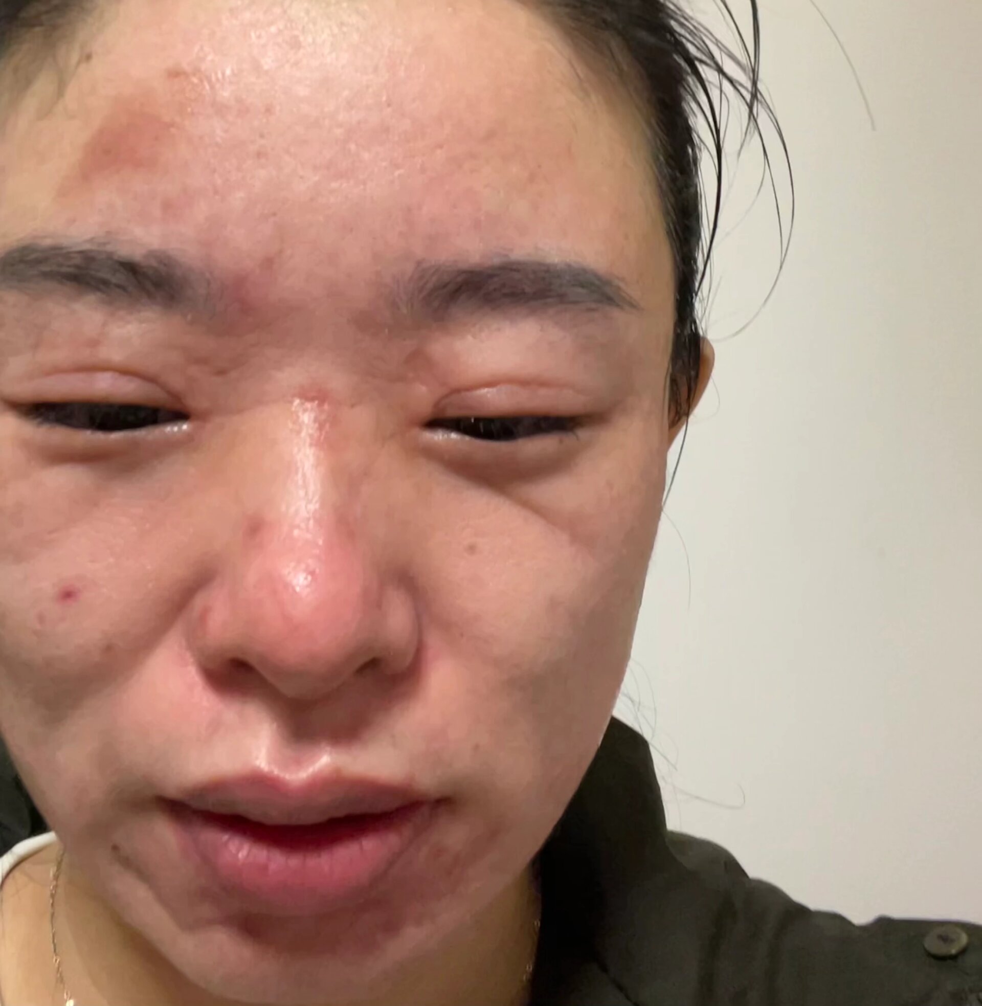 第一次敷面膜过敏