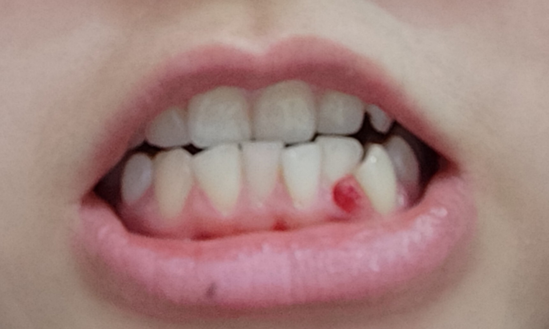 牙齿07间长了一坨肉,还会出血,不知啥子