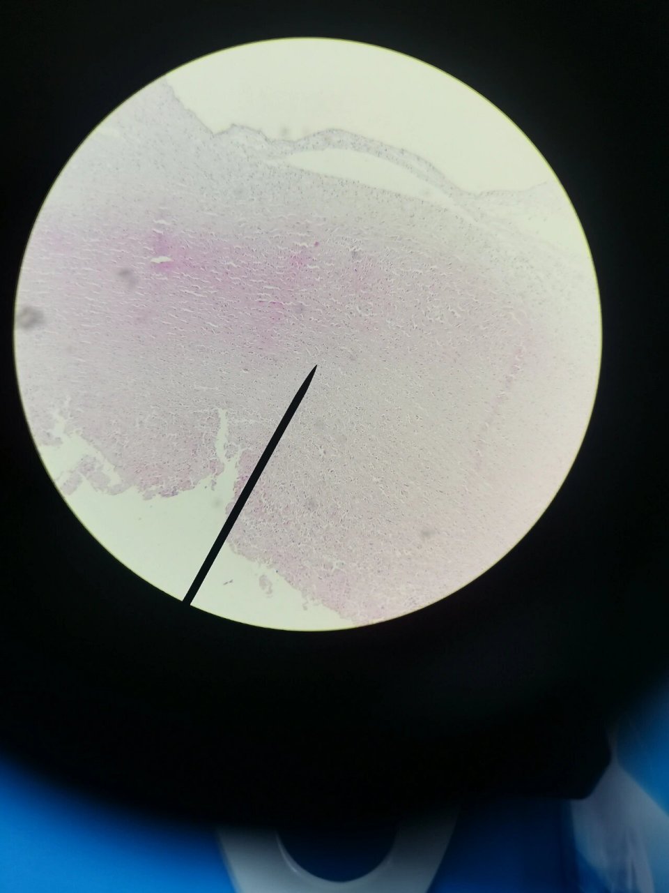 病理切片-动脉粥样硬化 诊断描述:低倍镜下可见血管内膜增厚,向血管