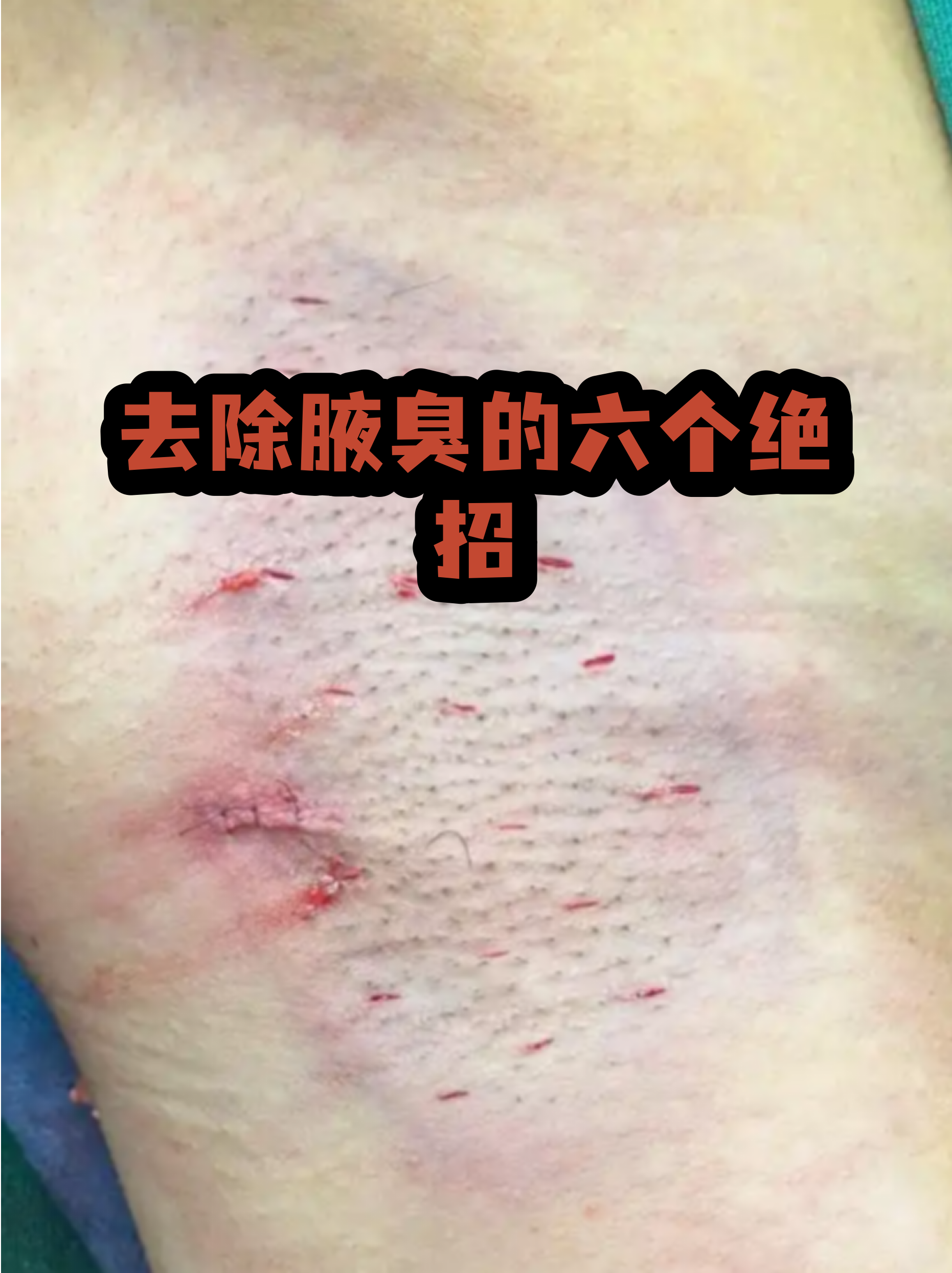 狐臭的腋窝症状图片(狐臭的腋窝和正常人有区别吗)