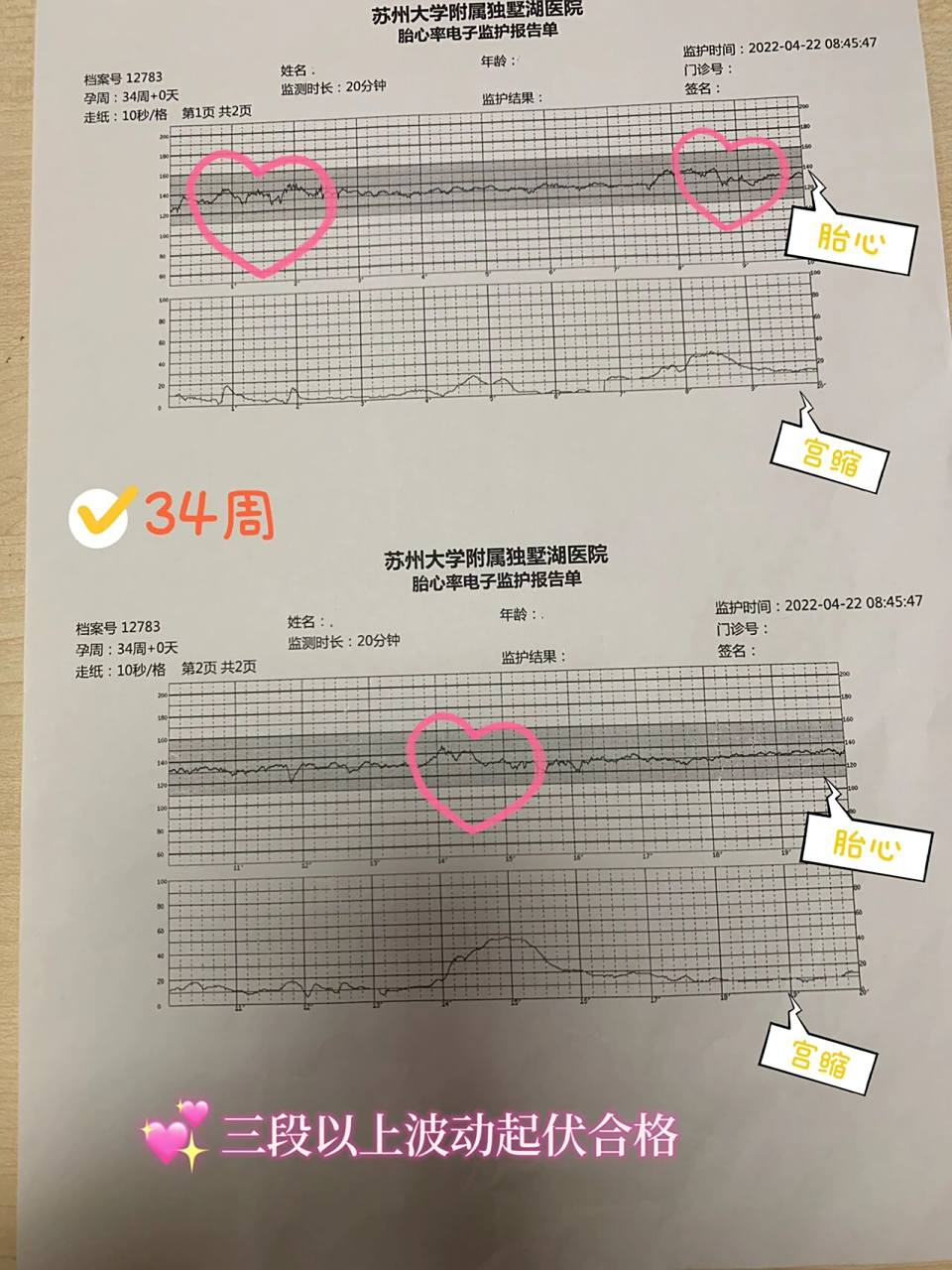 39周孕晚期,次次胎心监护一次过 7815胎心监护过程一般20分钟