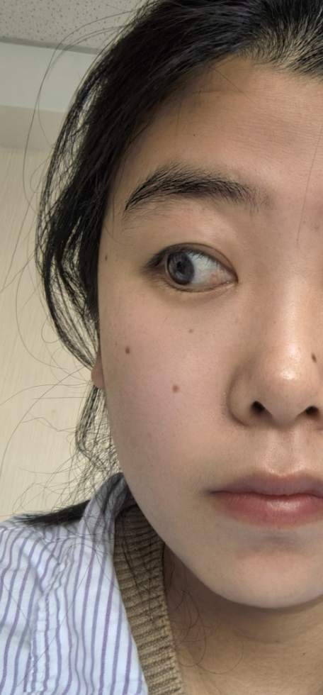 斜视手术需要做两只眼睛,主要是因为大多数斜视问题实际上涉及双. 