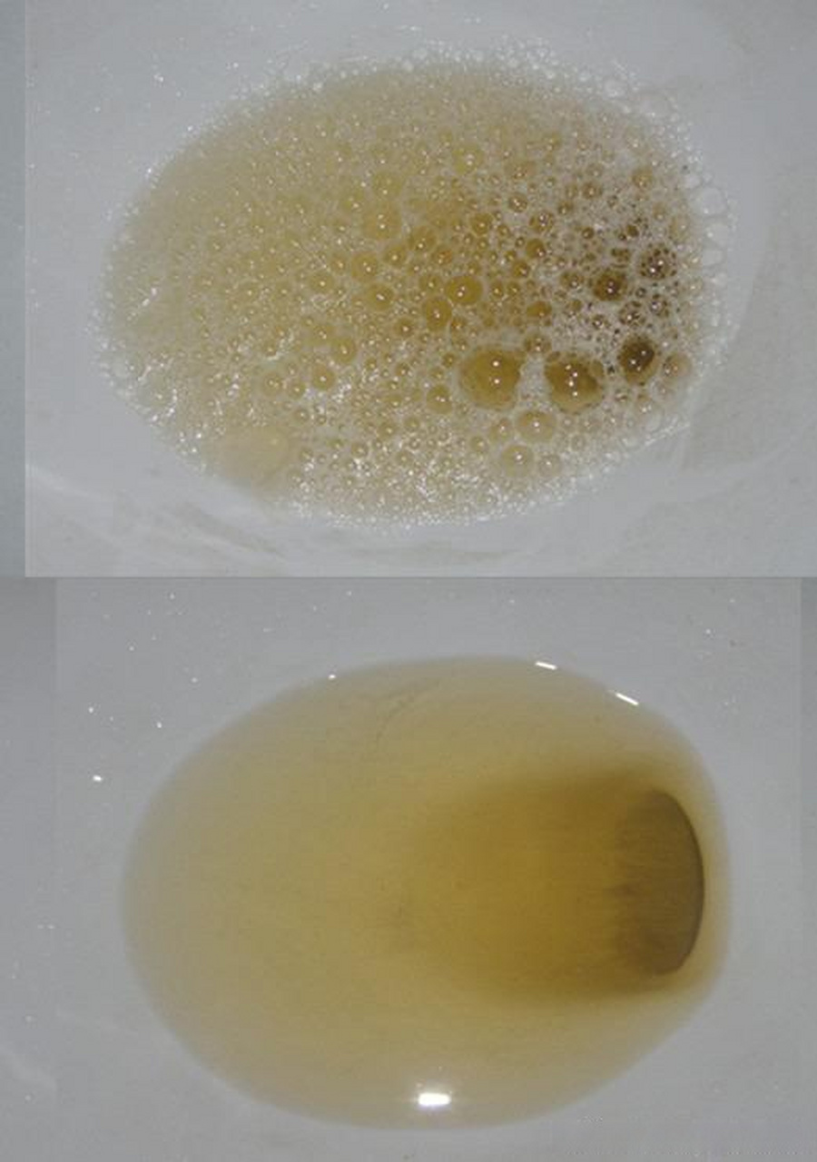 尿蛋白细小泡沫的图片图片
