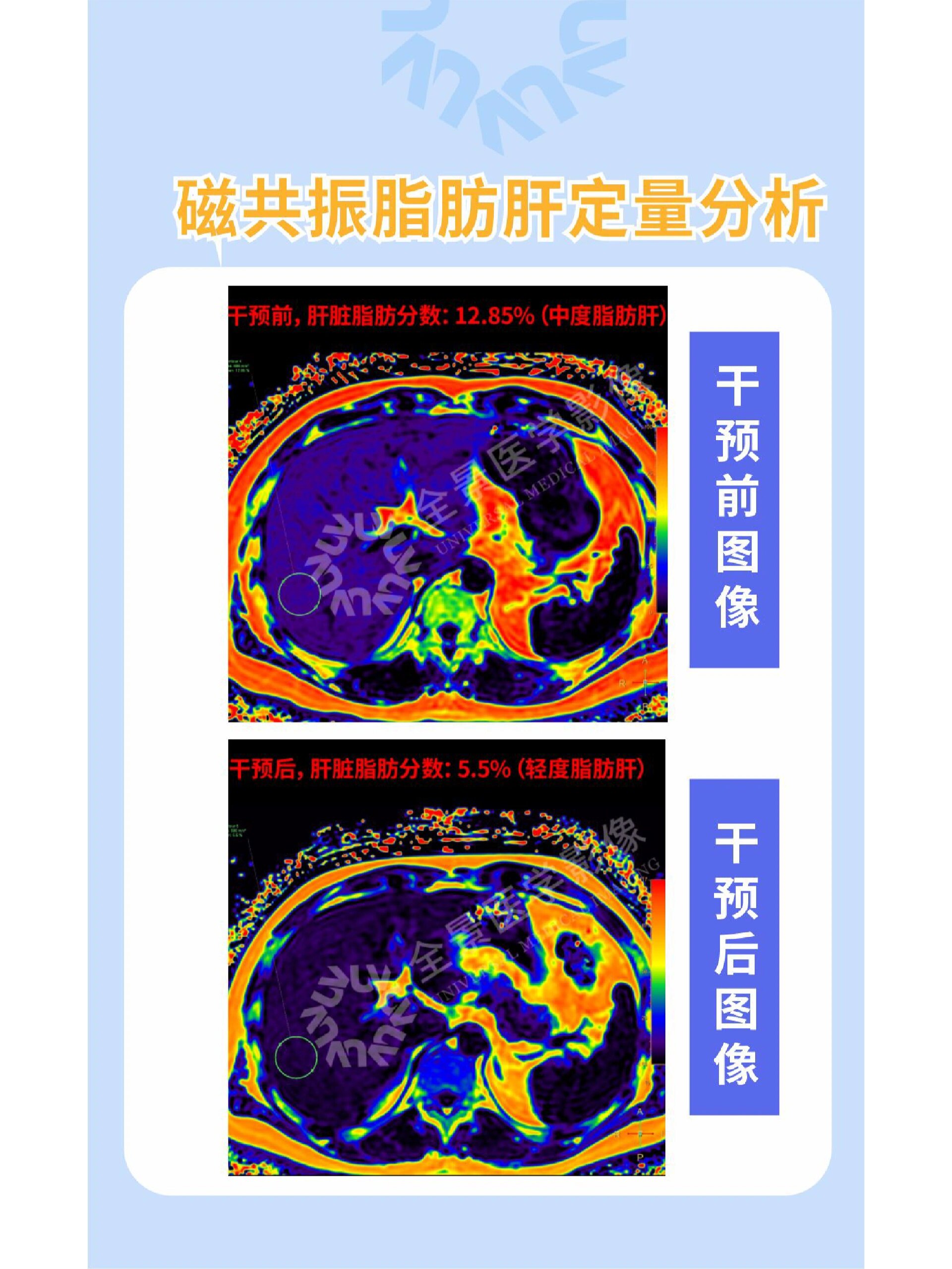 磁共振定量分析来👀 🚼脂肪肝是一种常见的肝脏病理性改变,指各种