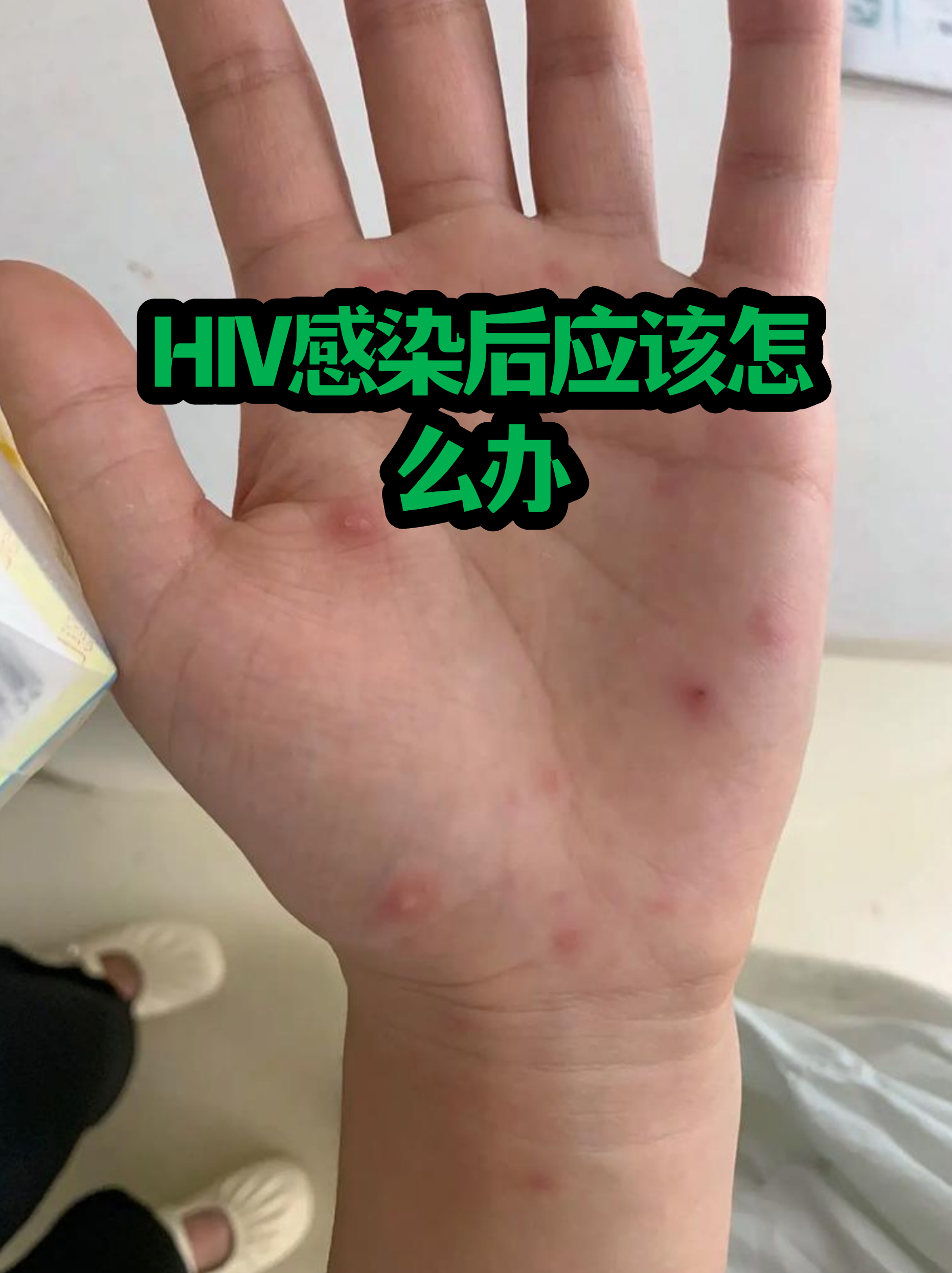  感染了疫情能治好吗(乙肝自愈的15个征兆)