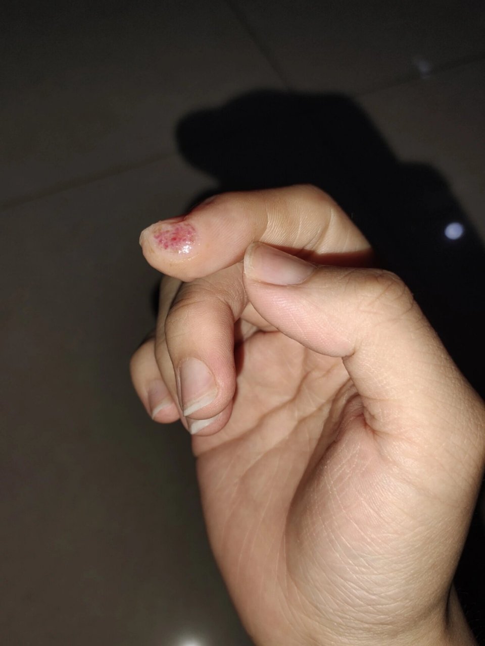 手指切掉一块肉第十天,湿性愈合第四天 伤口护理过程 1.