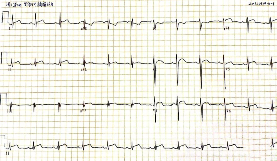 急性心包炎心电图图片