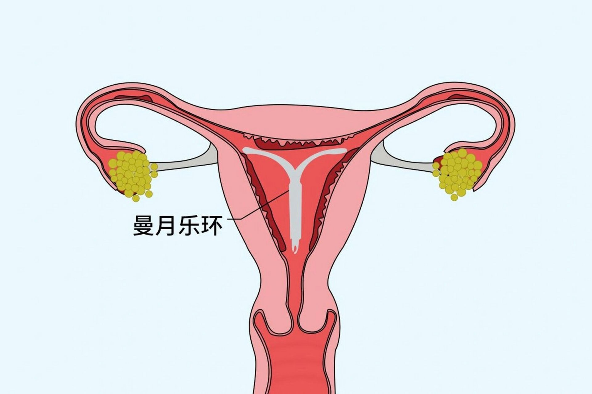 曼月乐环,对于很多子宫腺肌症的患者而言,那绝对是一款神器,治疗效果