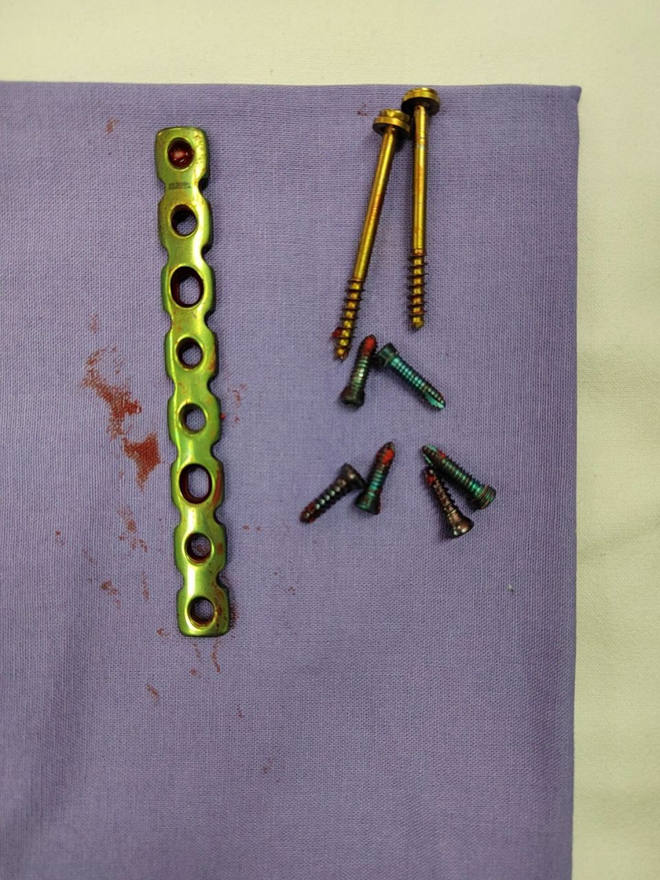 三踝骨折一年,今天终于拆钢板了 到18号整整一年,提前了几天.