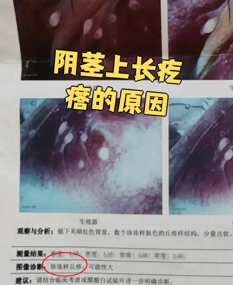 阴茎上长疙瘩可能是阴茎珍珠状丘疹,也有可能是