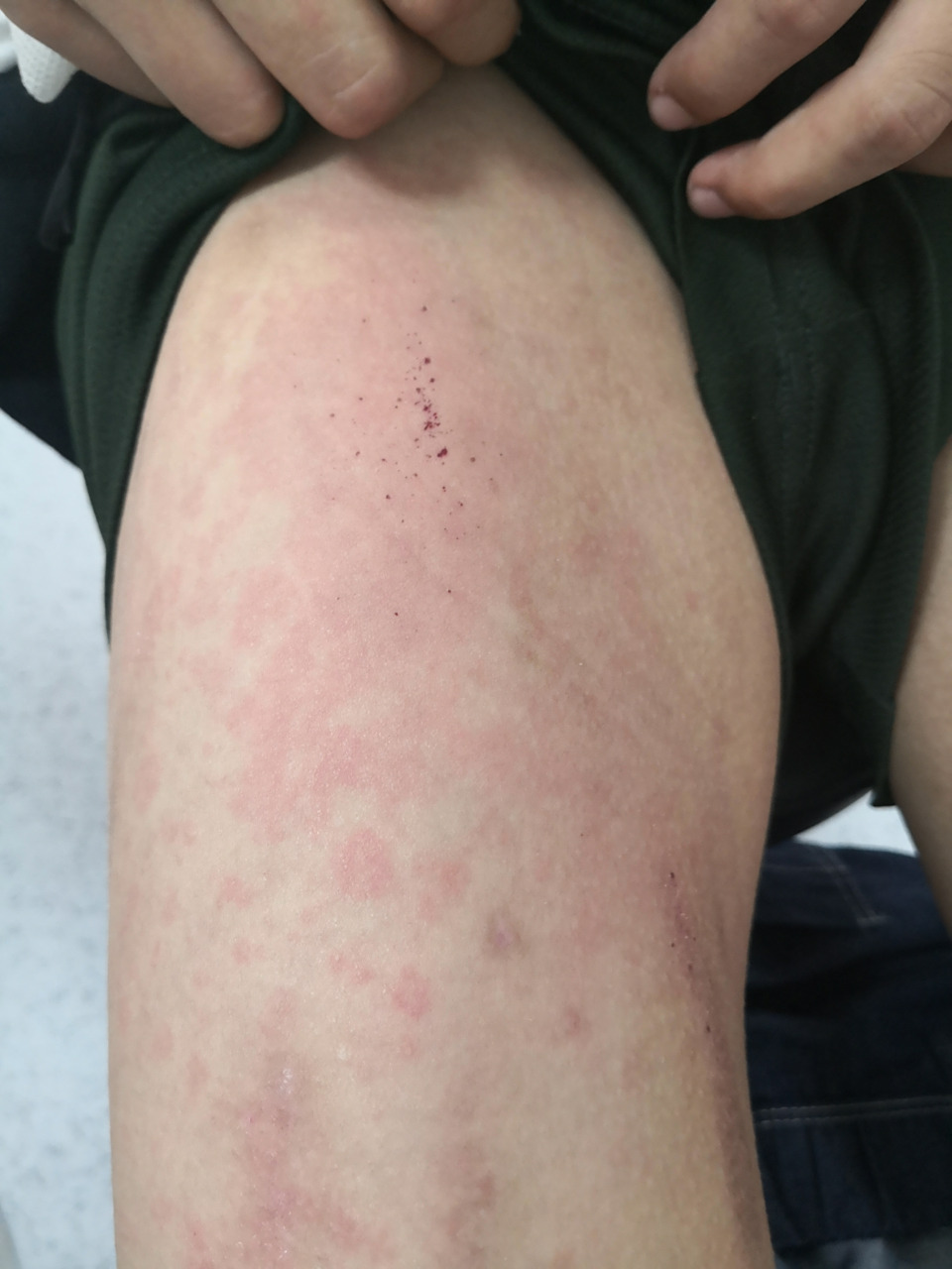 考虑药物过敏导致的荨麻疹症状#过敏##解决皮肤问题专注皮肤美容