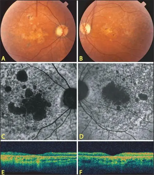 stargardt病是什么病
