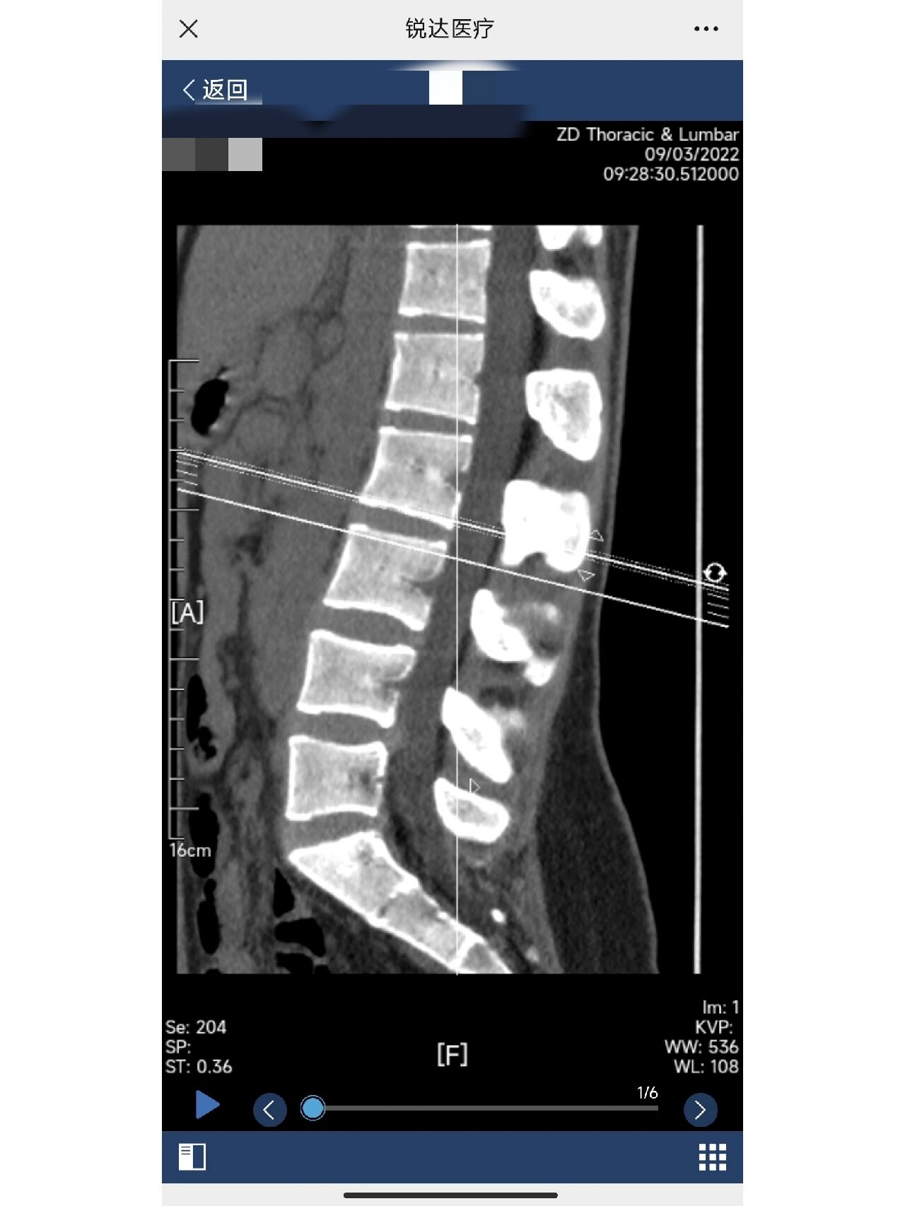腰突-ct腰椎横断位平扫影像
