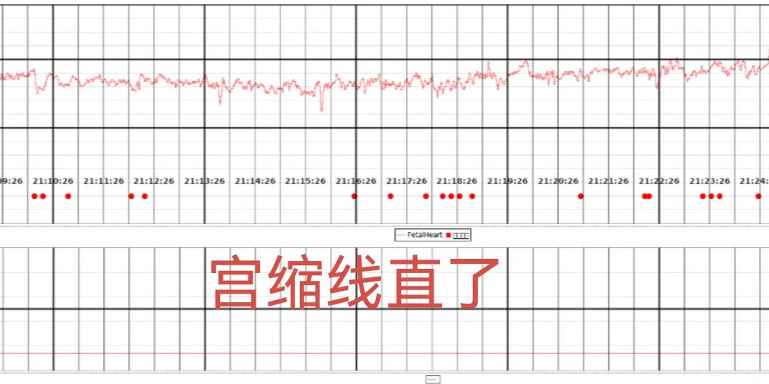 宫缩图怎么看图片