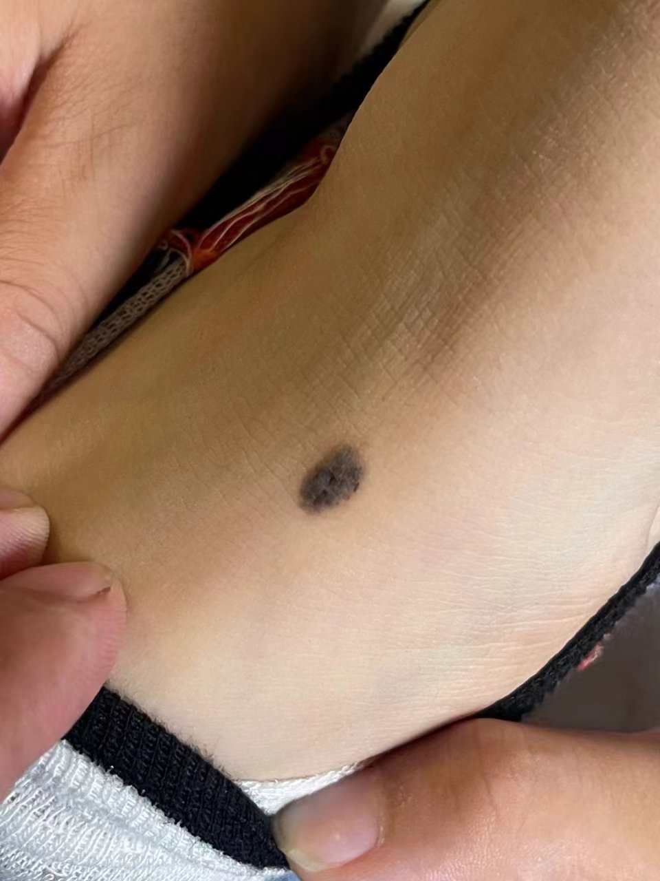 这种足部摩擦部位的色素痣,手术切除活检诊断一下比较好.