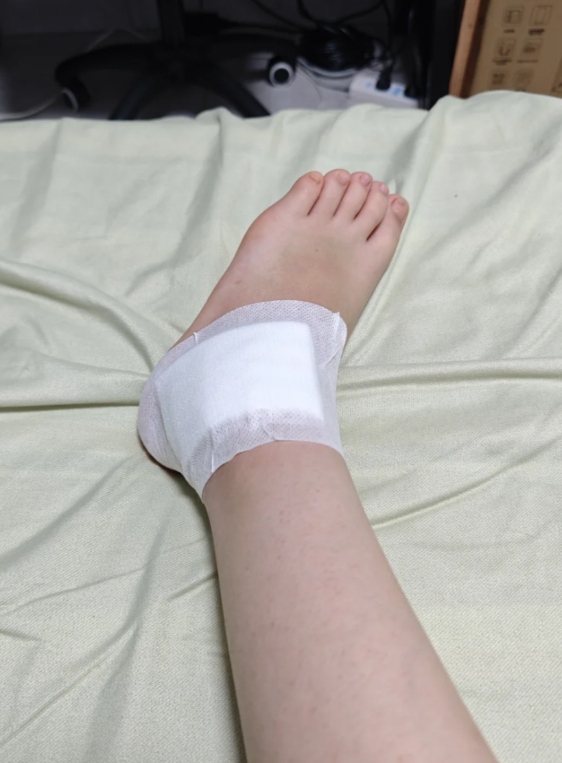 骨折时软组织可能受伤,毛细血管破裂出血,血液积在皮下,就会发青