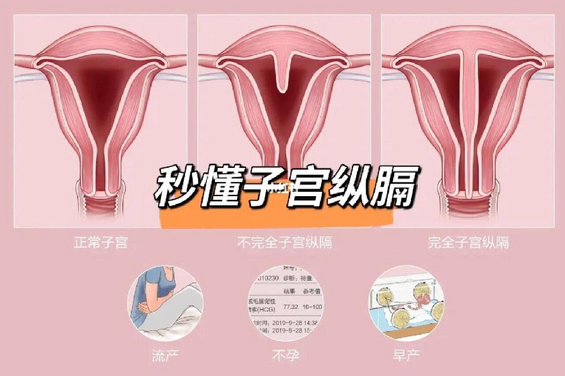 子宫纵膈,看这里👇 子宫纵隔是指女性胚胎在早期发育过程中,因双侧