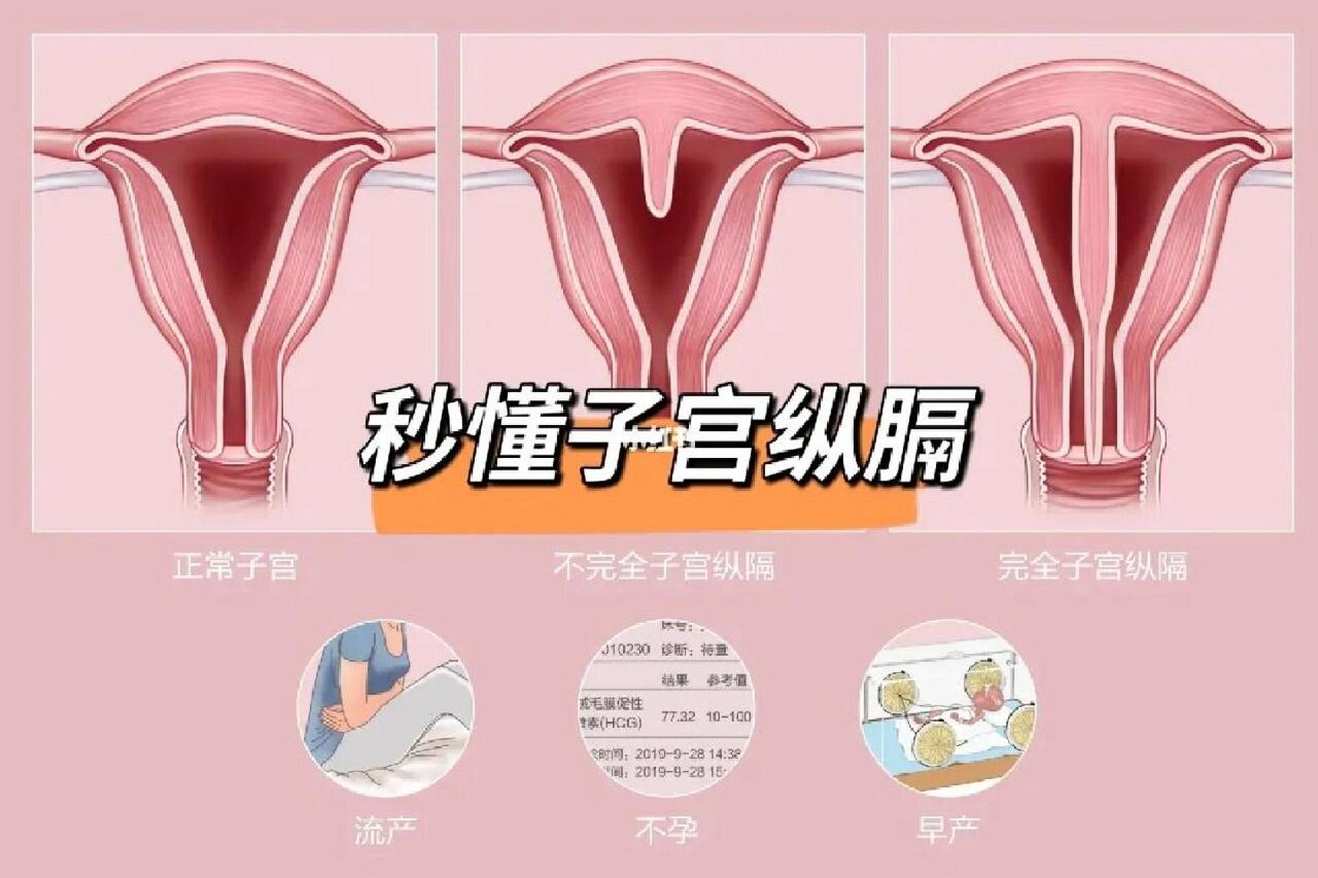 不全纵隔子宫y型图片图片