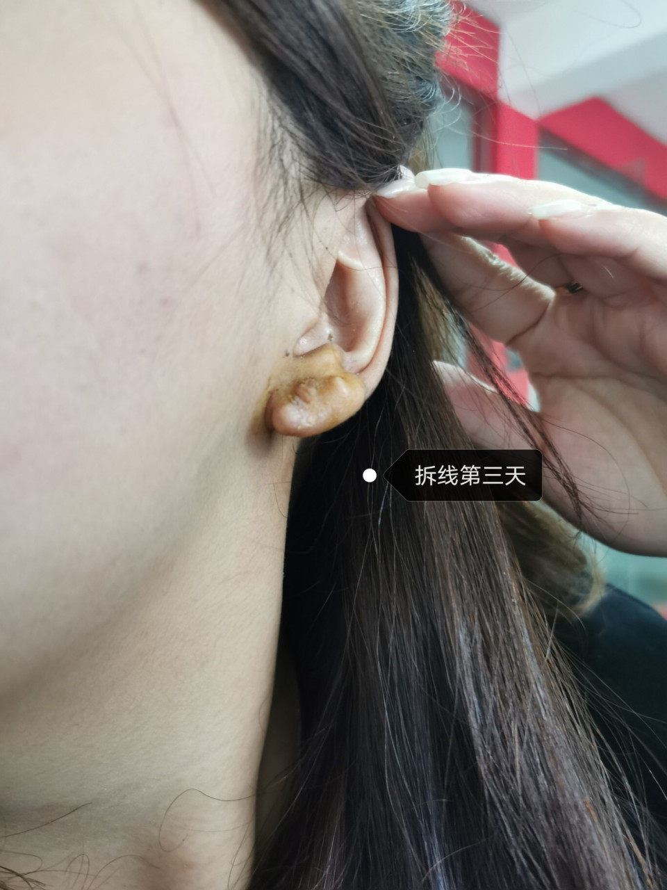我做手术之前的样子,因为打耳洞后来灌脓引起的,也没注意疙瘩越来越大