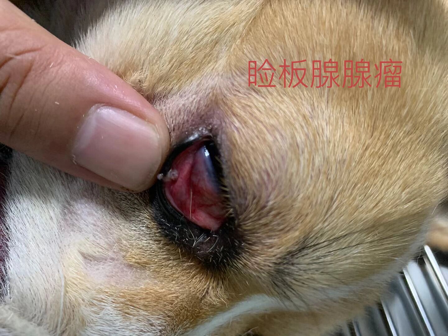 其为眼睑睑板腺原发的肿瘤,有些生长快速,可能变成恶性的肿瘤(睑板