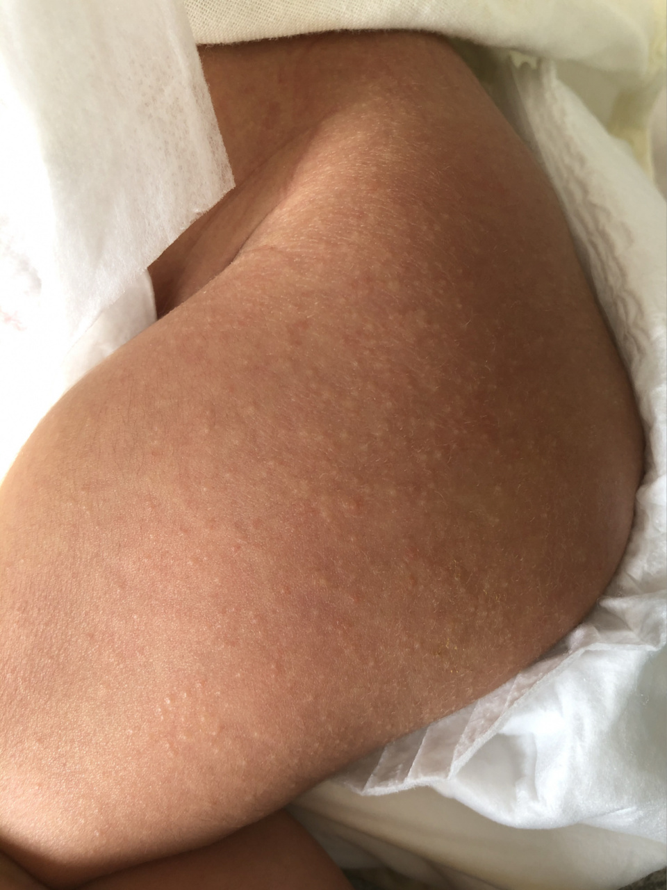 宝宝疹子 谁帮我看看宝宝身上这是什么疹子,白色的密密麻麻一片,像